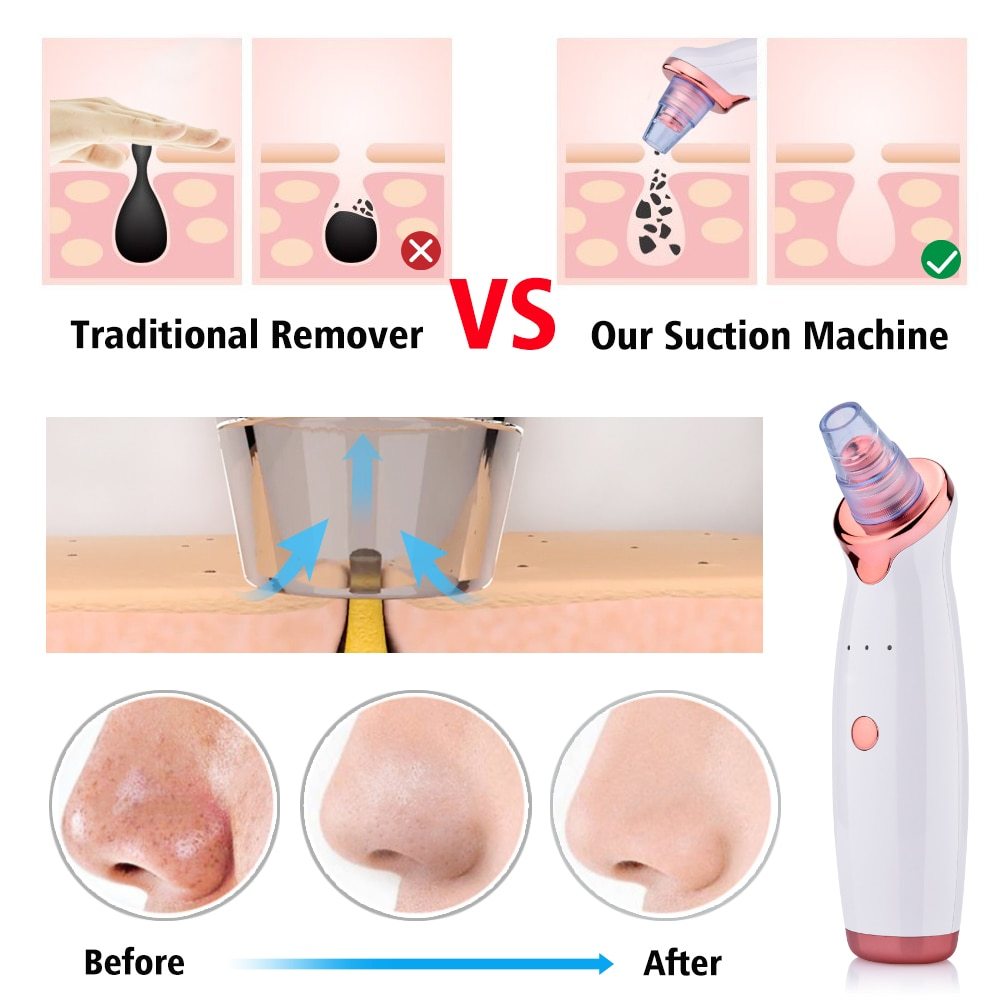 Blackheads Remover, Vacuum Pore Cleaner For Face, USB Rechargeable